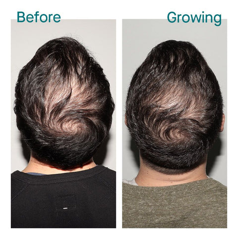 Nutrafol Hair Serum Men Before After